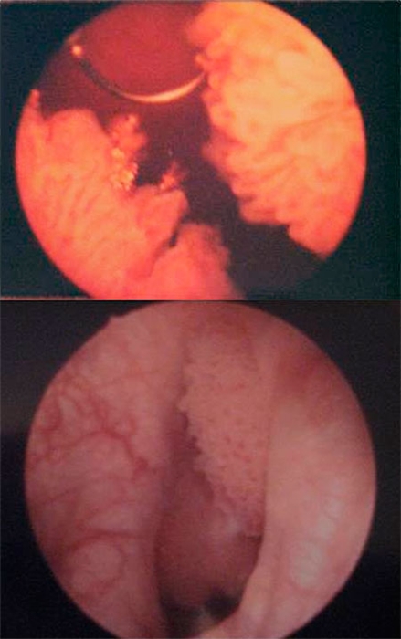 Опухоль мочевого пузыря фото 33