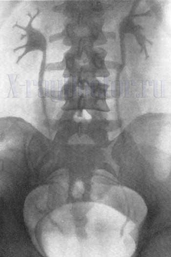 Обследование почек при помощи рентгена