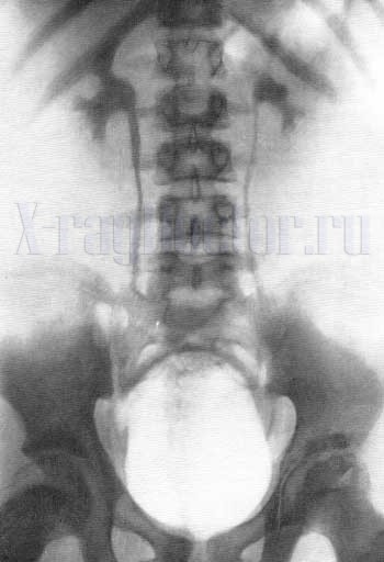Обследование почек при помощи рентгена