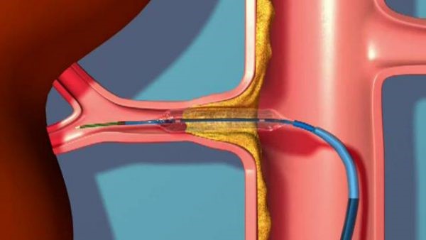 Как распознать и вылечить стеноз почечной артерии
