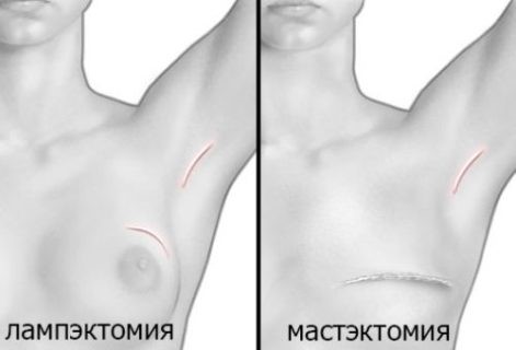 Удаление опухоли груди