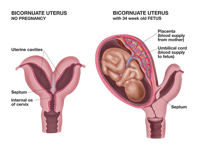 Врождённая аномалия органов: удвоение почек при беременности