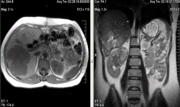 МРТ печени – диагностика заболеваний печени