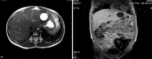 МРТ печени – диагностика заболеваний печени