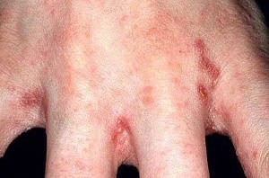 Высыпания на коже – основные признаки недугов печени