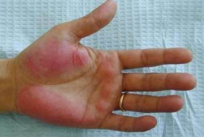 Высыпания на коже – основные признаки недугов печени
