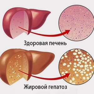 Методы лечения диффузных изменений паренхимы печени и поджелудочной железы