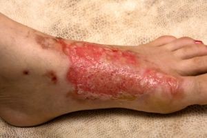 Заживление повреждений кожи: мнение врача