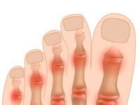 Что делать если немеют пальцы на ногах: онемение на правой и на левой ступне