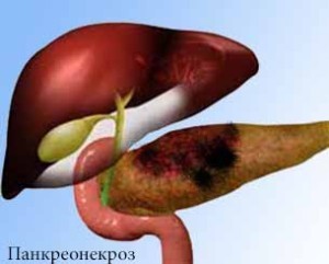 Развитие панкреонекроза поджелудочной железы и летальный исход заболевания