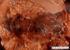 Лечение панкреонекроза поджелудочной железы