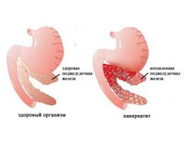 Причины, симптомы и лечение реактивного панкреатита