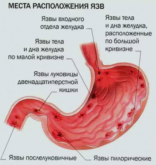 Причины тошноты и тяжести в желудке