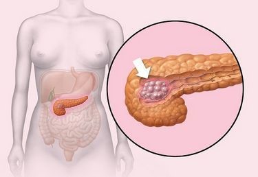 Жировая инфильтрация поджелудочной железы: причины, симптомы и способы лечения