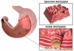 Лечение эрозий антрального отдела желудка