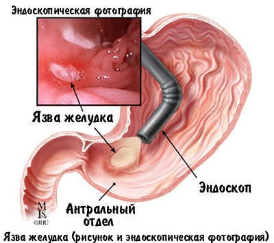 Как проводится гастроскопия желудка без глотания зонда