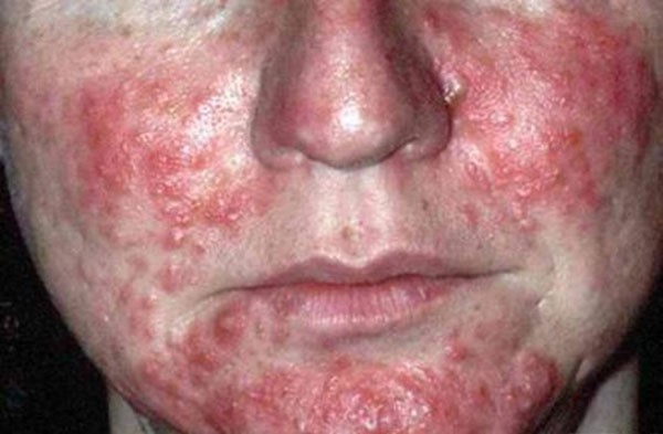 Как проявляются симптомы хеликобактер пилори на лице