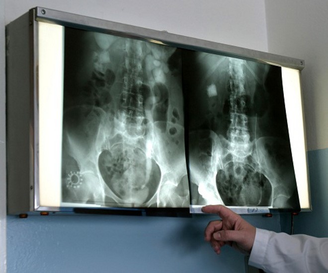 Показания к проведению рентгеноскопии желудка