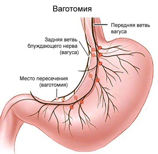 Симптомы и лечение кровотечения в желудке