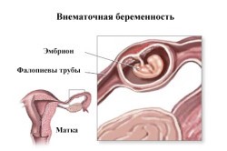 Боли в кишечнике при беременности