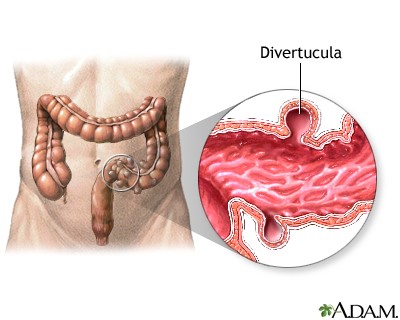 Дивертикулез кишечника: симптомы и лечение заболевания