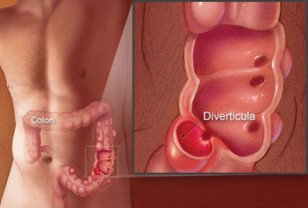 Дивертикулез кишечника: симптомы и лечение заболевания