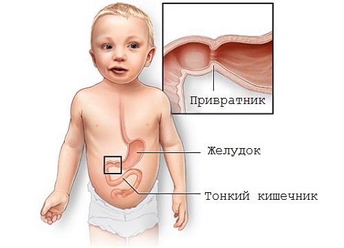 Симптомы и лечение энтерита у детей