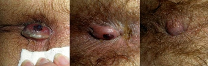 О лечении тромбоза геморроидального узла или геморроидального тромбоза (с фото)