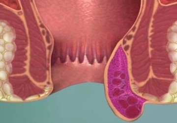 О лечении тромбоза геморроидального узла или геморроидального тромбоза (с фото)