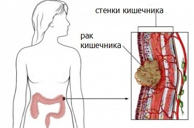 Распространенные симптомы рака кишечника у женщин