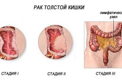 Признаки и симптомы рака кишечника