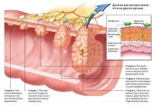 Онкология кишечника