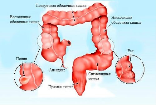 Стадии и симптомы рака сигмовидной кишки