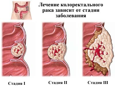 Симптомы и лечение рака толстой кишки