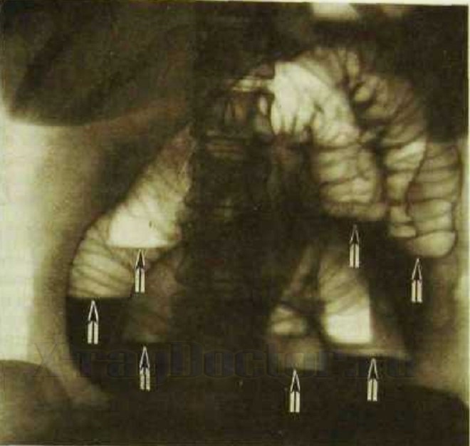 Неинвазивный метод исследования - рентген брюшной полости