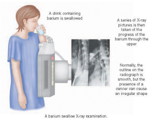 Как проводится рентген кишечника с контрастом (с барием)