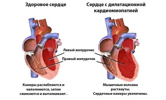 Развитие заболевания кардиомиопатия: симптомы и методы лечения