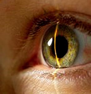 Ангиопатия сосудов сетчатки глаза у беременных, как осложнение гестоза