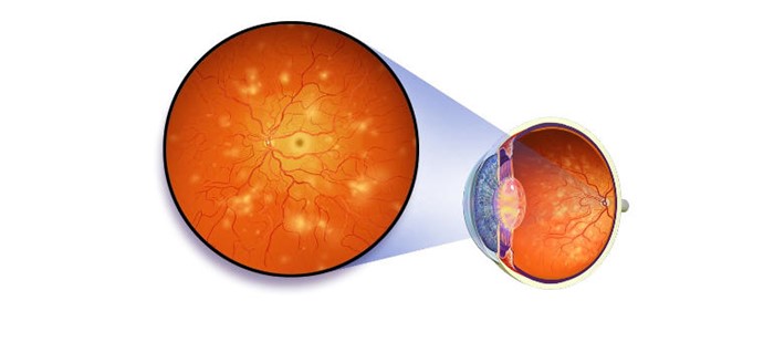 Ангиопатия сетчатки глаза и нарушение мозгового кровообращения