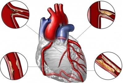 Операция стентирования сосудов сердца: что важно знать о ней?
