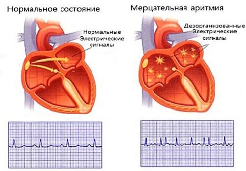 Способы лечения аритмии сердца