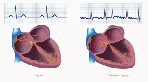 Способы лечения аритмии сердца