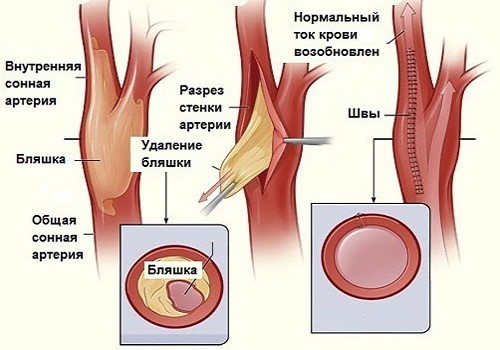 Брахиоцефальные артерии, сосуды (БЦА): анатомия, УЗДГ и другие способы диагностики патологии