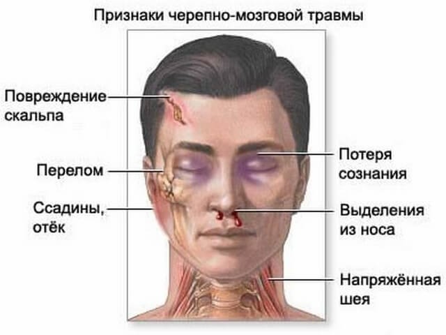 Черепно-мозговая травма (ЧМТ): симптомы, лечение, последствия