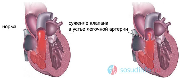Что такое сердечный горб