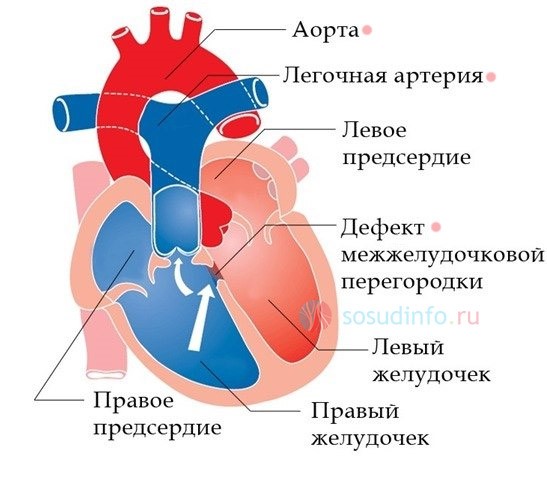 Что такое сердечный горб