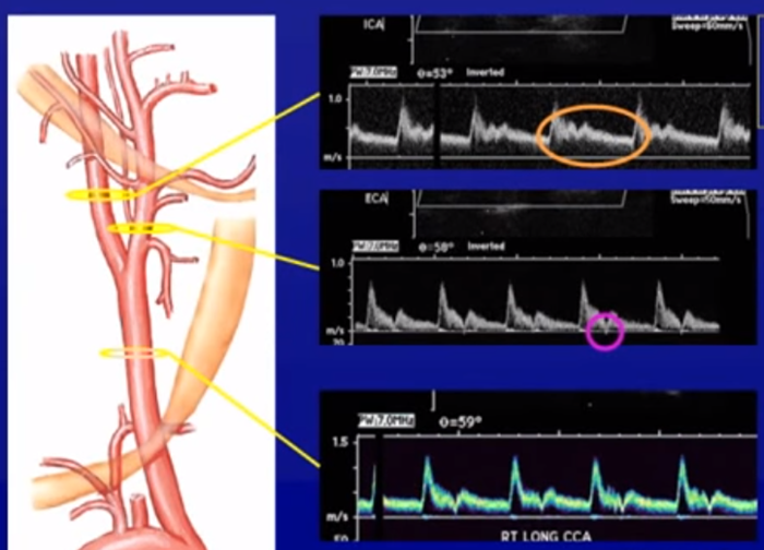Ультразвуковое дуплексное сканирование брахиоцефальных артерий