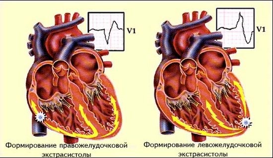 Опасно ли появление экстрасистол в сердце?