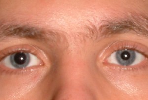 Фоновая ретинопатия глаз