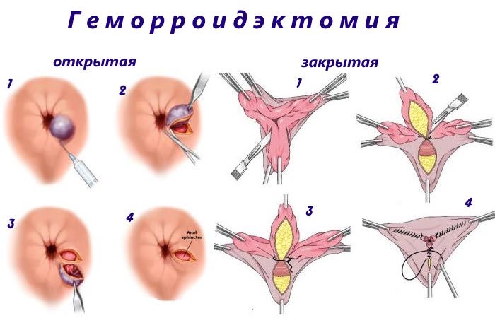 Геморроидэктомия: операция по удалению геморроя, геморроидальных узлов